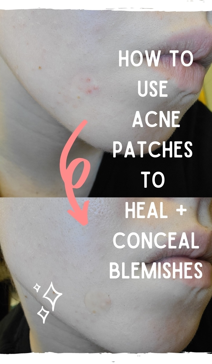 Aftercare for an Inflamed Blemish with Acne Patches